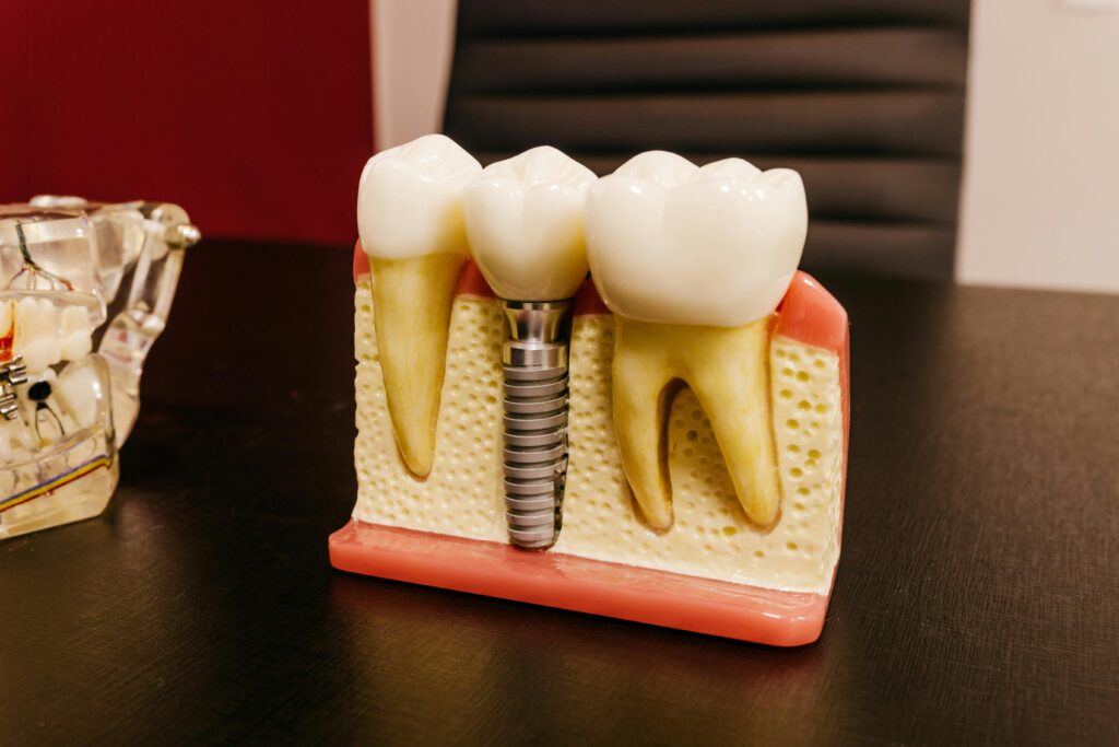 Dental Implants in Albany