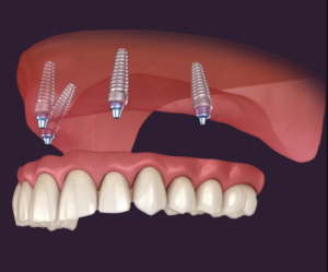 All on 4 Dental Implants