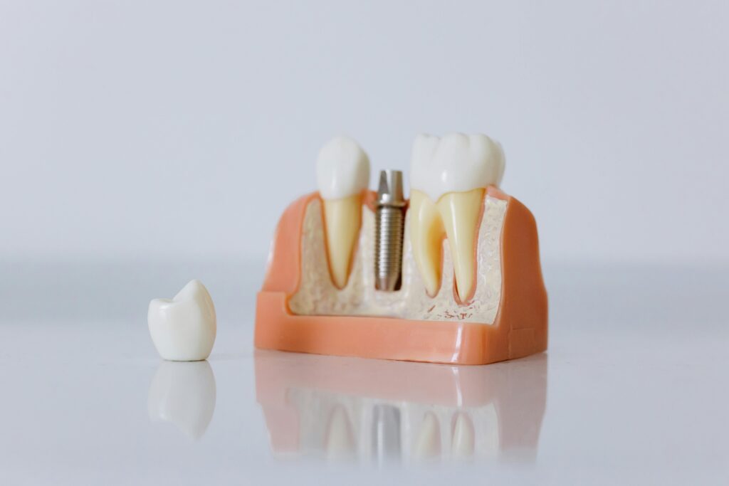 Dental Crowns Near Me